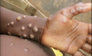 MONKEYPOX: Kenya confirms first case in passenger traveling from Uganda