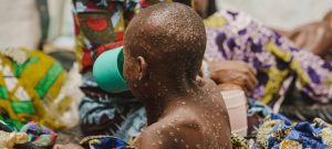 W.H.O. authorizes Mpox vaccine, clearing way for use in Africa