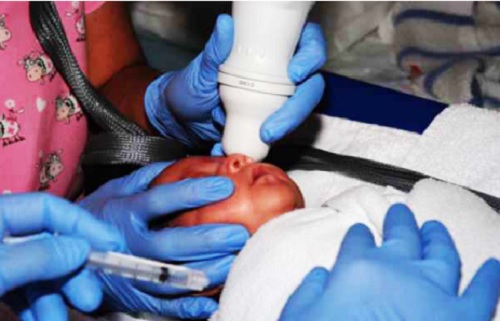 Blinding disease affecting premature babies