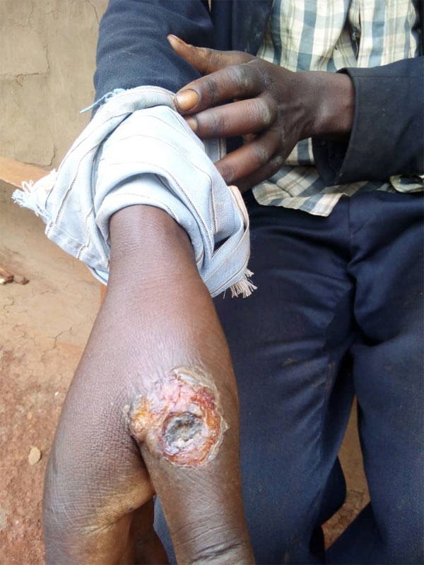 Five hospitalized as anthrax hits Kazo