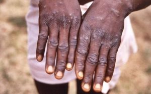 Herbalists in Busoga opt for local remedies to manage mpox